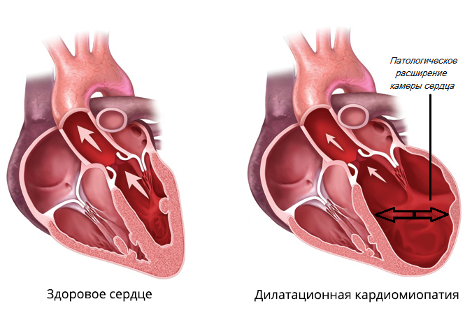 дилатационная кардиомиопатия
